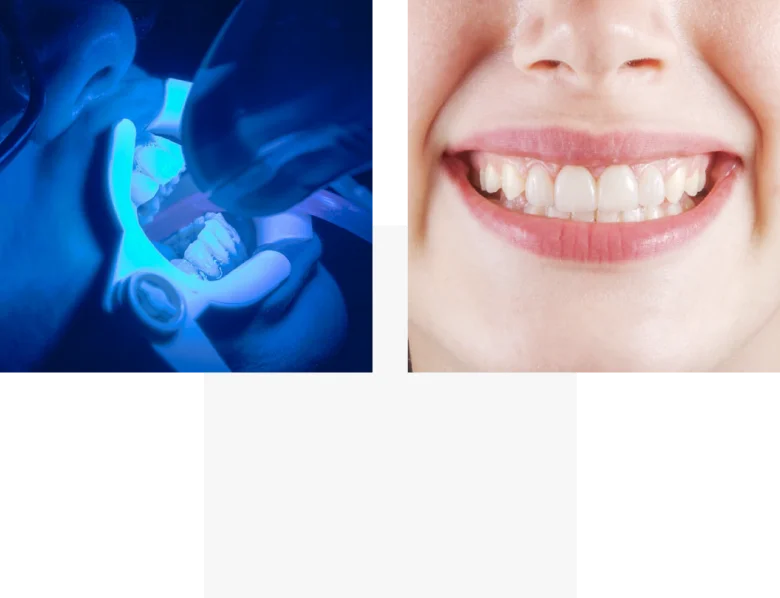 Blanqueamiento dental - Servicios YanesDent